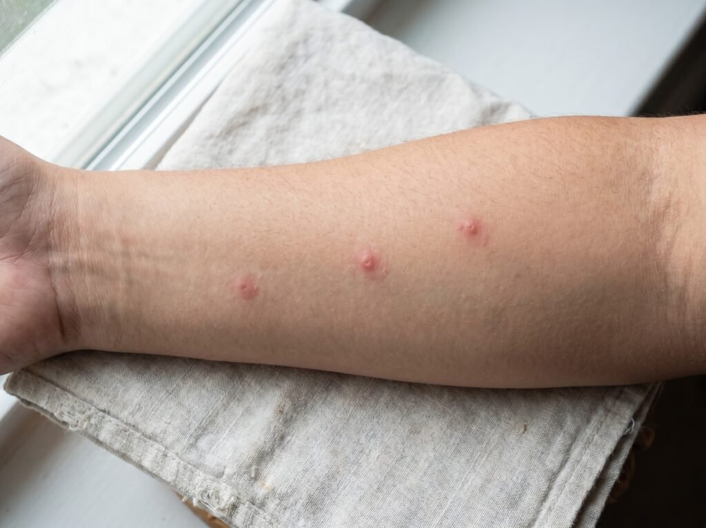 small red papules on human forearm from chicken mite bites